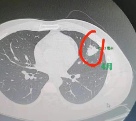 在门诊坐诊时，经常会遇到一些让人惋惜的病例，今天这个35岁男性患者的情况，就特别