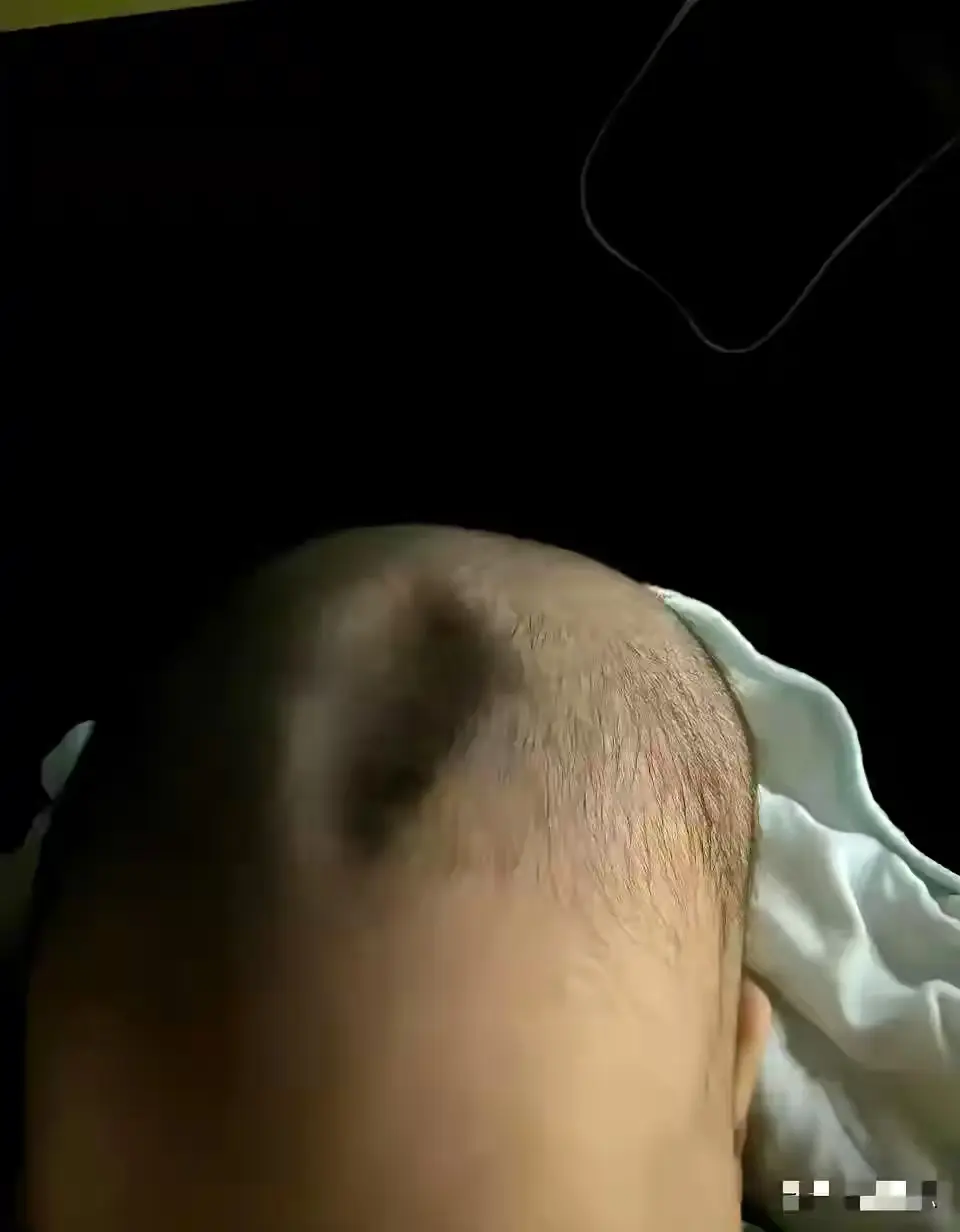 孩子头上这样的，有事吗？