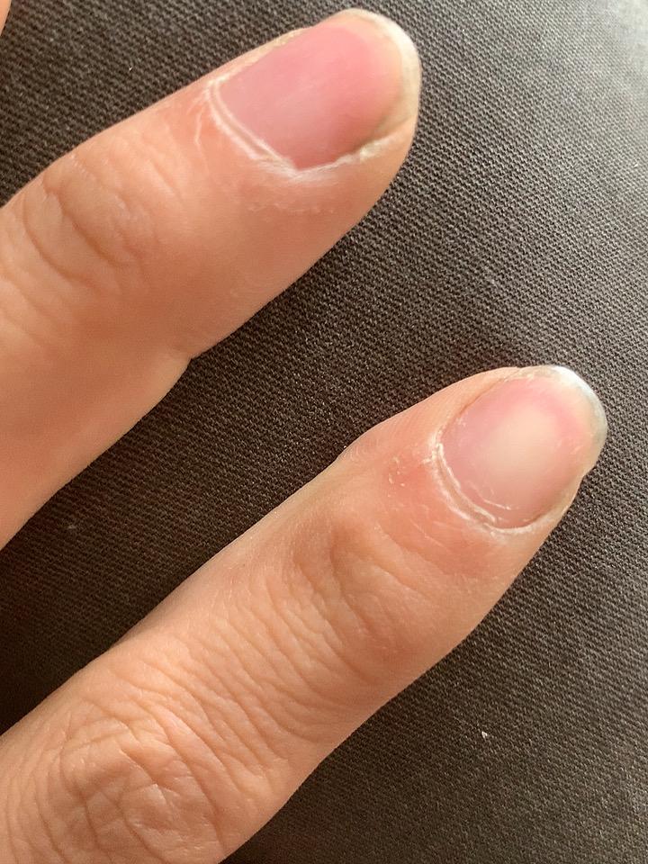 手指长“倒刺”，医学上称为逆剥。倒刺是指从甲皱襞的近端或侧缘开裂而翘起的小块长三