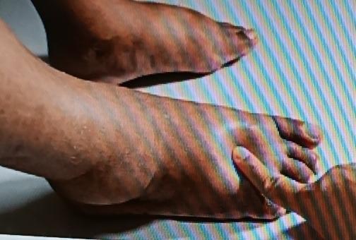 中老年人下肢水肿可太闹心了，不过有几个简易方法能试试。抬高下肢就是个好办法。晚