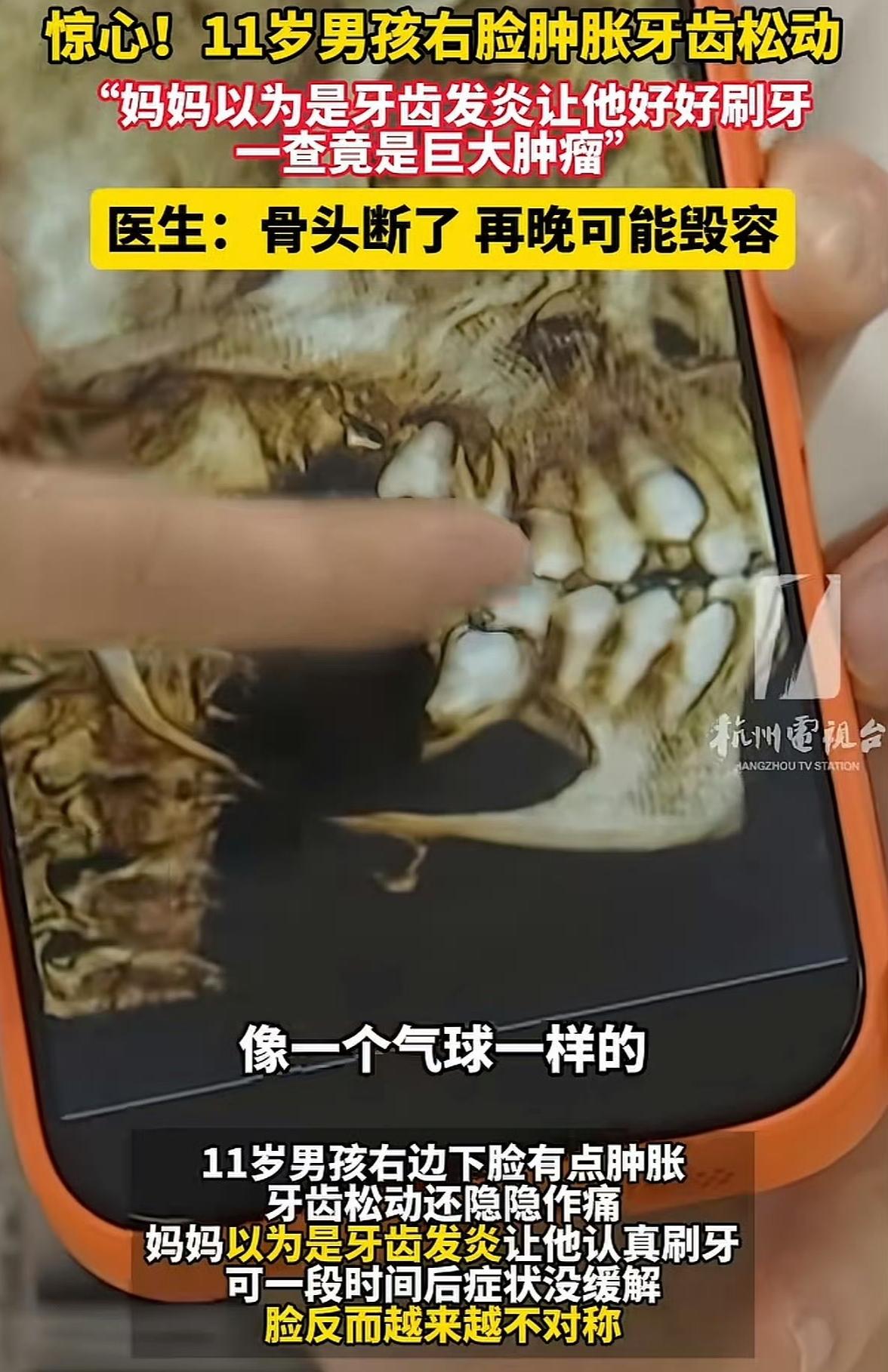 杭州一个11岁男孩脸肿、牙齿松动，家长一开始以为是牙齿发炎，让孩子认真刷牙，结果