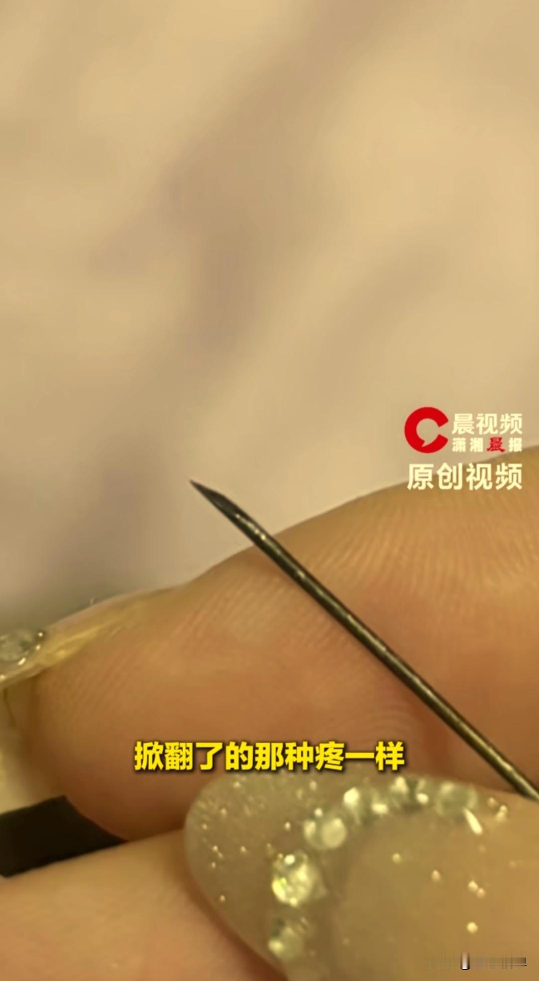 浙江18岁女生小鱼，臀部隐隐疼了一个多月，一开始她以为只是运动拉伤，没放在心上。