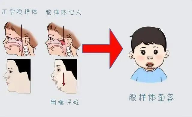 85%的腺样体肥大孩子，想要不发作、不反复，用这个方法就够了！医院却闭口不提