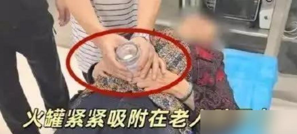 悲剧还是发生了！贵州贵阳，一七旬老人自行在家用塑料罐拔火罐，却因时间太久导致塑料