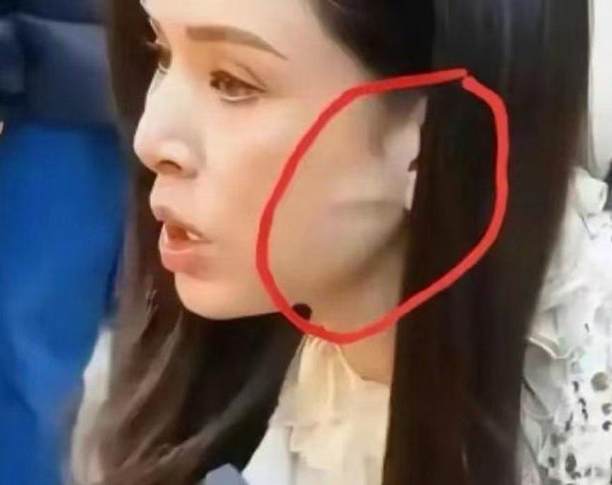 搞不懂了，李若彤不是没有医美过吗？这耳前凸起的一条线是啥