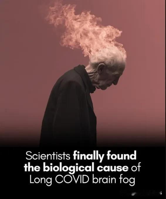 长期的新冠病毒脑雾是真实的——现在，我们知道是什么原因造成的。突破性的脑部扫