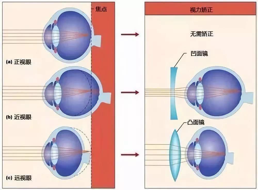 80后遇到眼睛老花的痛苦！去年还是青少年近视今年就开始佩戴老花镜，就问往哪里说理