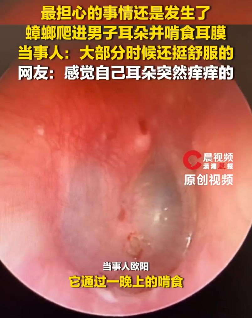 担心的事情还是发生了！广东深圳，男子一觉醒来发现耳朵难受，去医院检查后得知，耳朵
