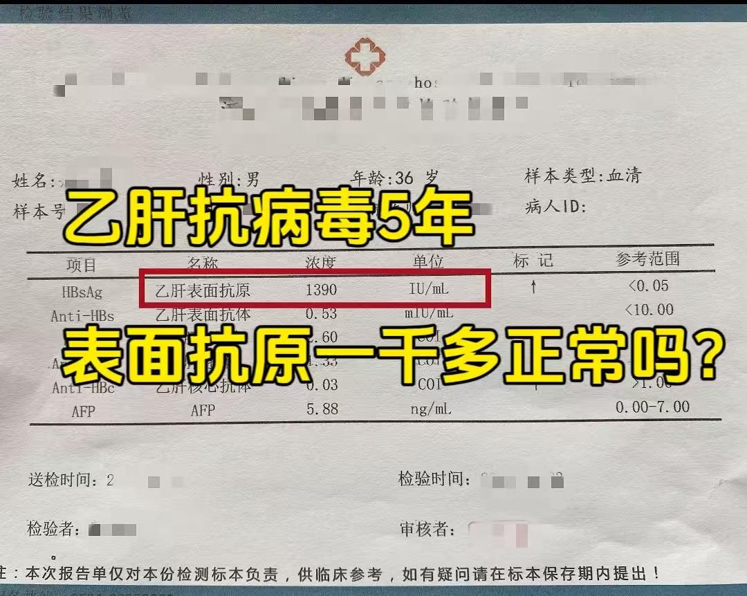 这张报告单来自一位抗病毒治疗5年的山东乙肝患者，表面抗原是1390，患...