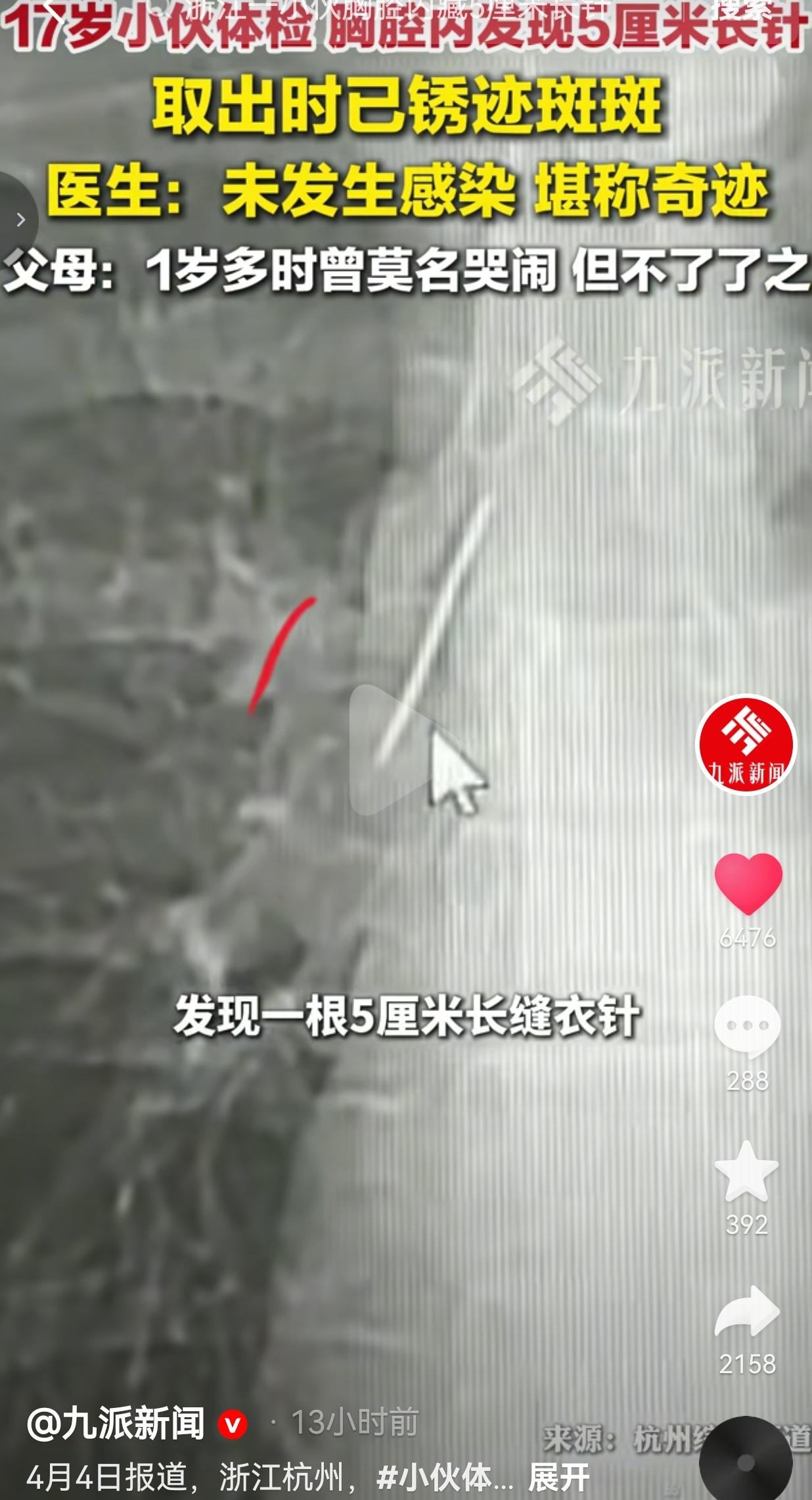 想想浑身发麻、后背发凉！浙江杭州一个17岁的小伙子，去参军体检拍CT，居然在肺组