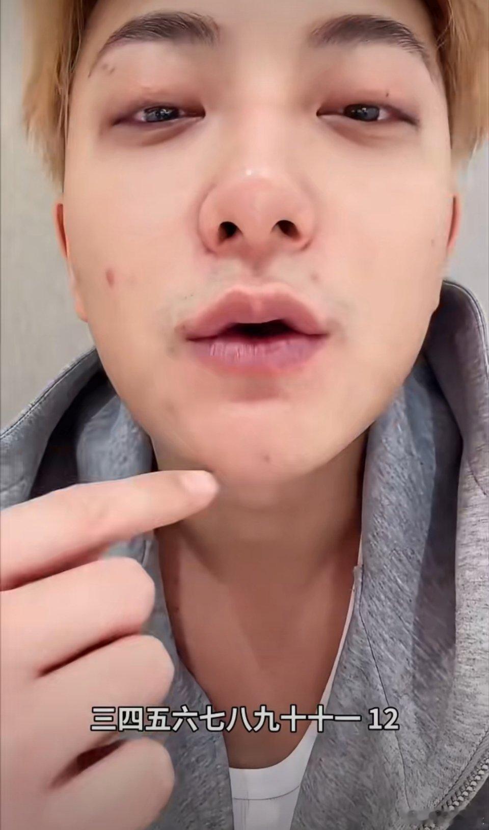 黄子韬脸上长了十二颗痘黄子韬直播太接地气了，无美颜无滤镜，细数脸上12颗痘，就问