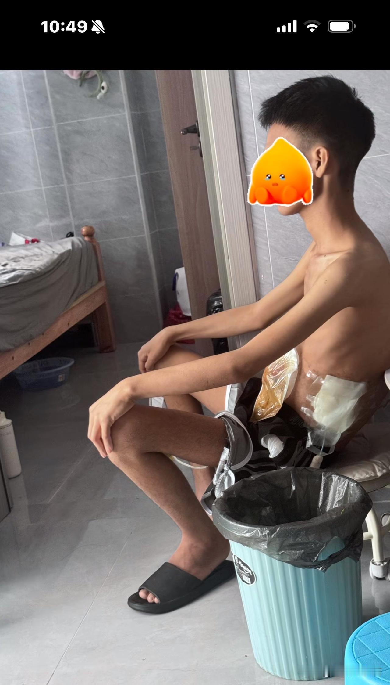 太可怕了，21岁男孩患肠癌晚期，治了1年多，还是没有手术机会，最近已经出现耐