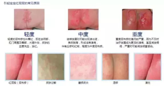 拒绝红屁屁, 月嫂支招搞定尿布疹