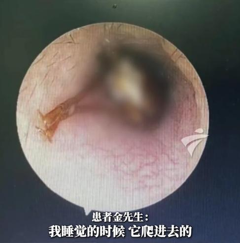“悲剧还是发生了！”近日，广东广州，一男子睡觉时，耳朵突然传来剧痛，他醒来后能感