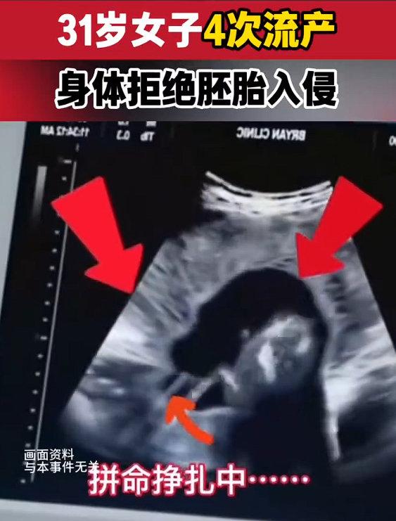 福建31岁的汪女士，这八年过得太煎熬了。结婚后满心期待要个宝宝，可四次怀孕都没能