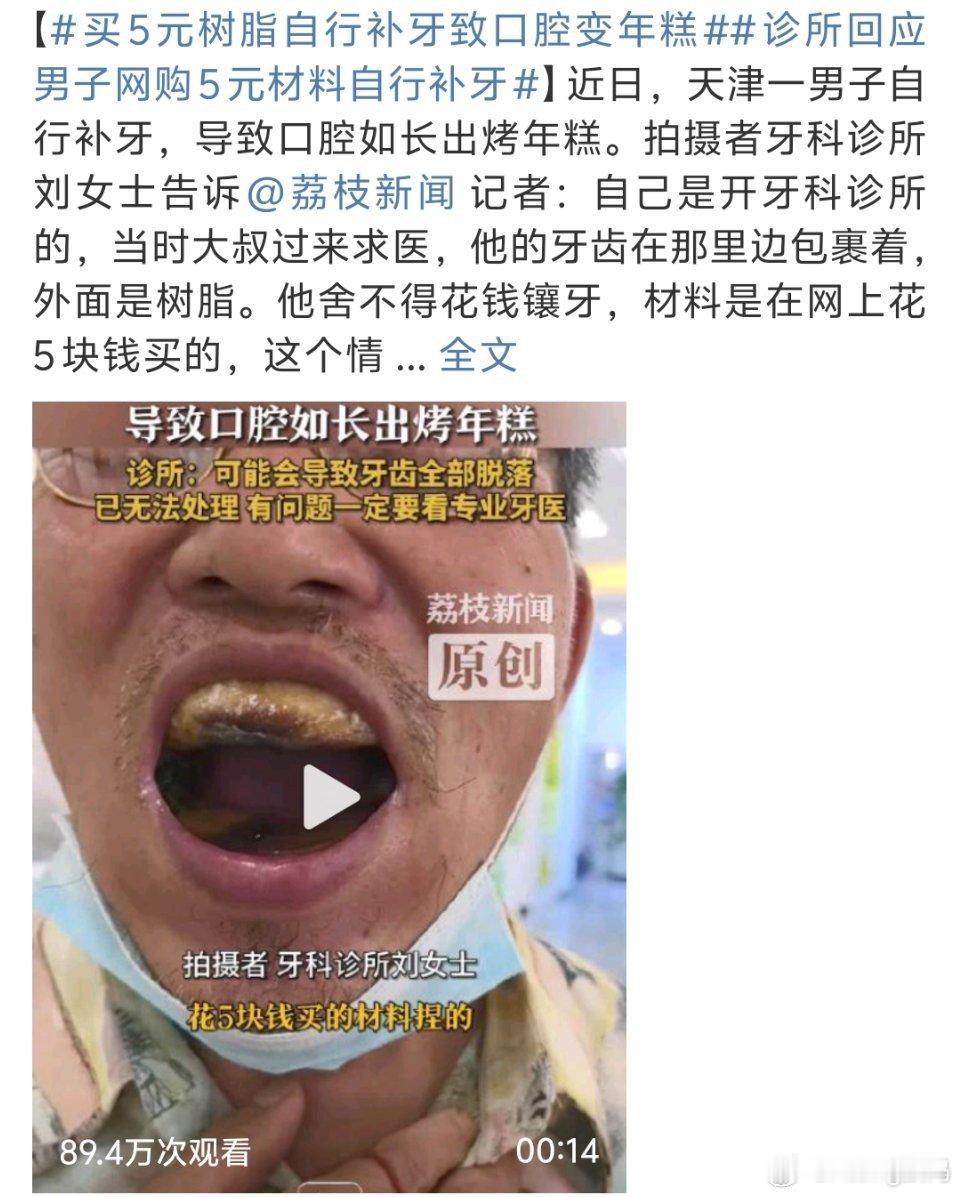 买5元树脂自行补牙致口腔变年糕天啊有点太离谱了要是自己能补要牙医有何用不过也是补
