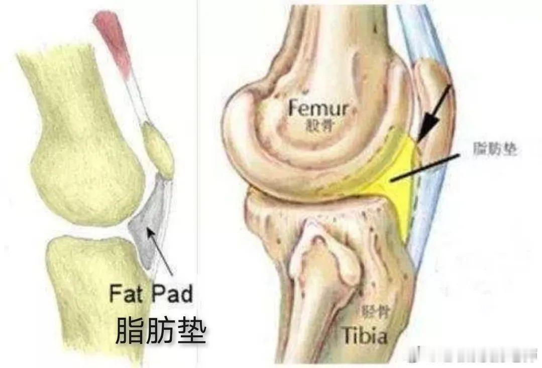 脂肪垫炎好久没讲这种膝盖损伤了——对于膝关节疼痛，常见的原因除了髌骨软化、髌腱