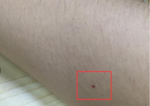 手臂上突然出现针尖大小的红点, 这是怎么回事?