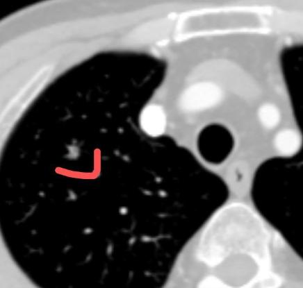 短短6个月，肺结节就从6毫米长到了8毫米？这位患者今年63岁，专程从外地坐飞机来