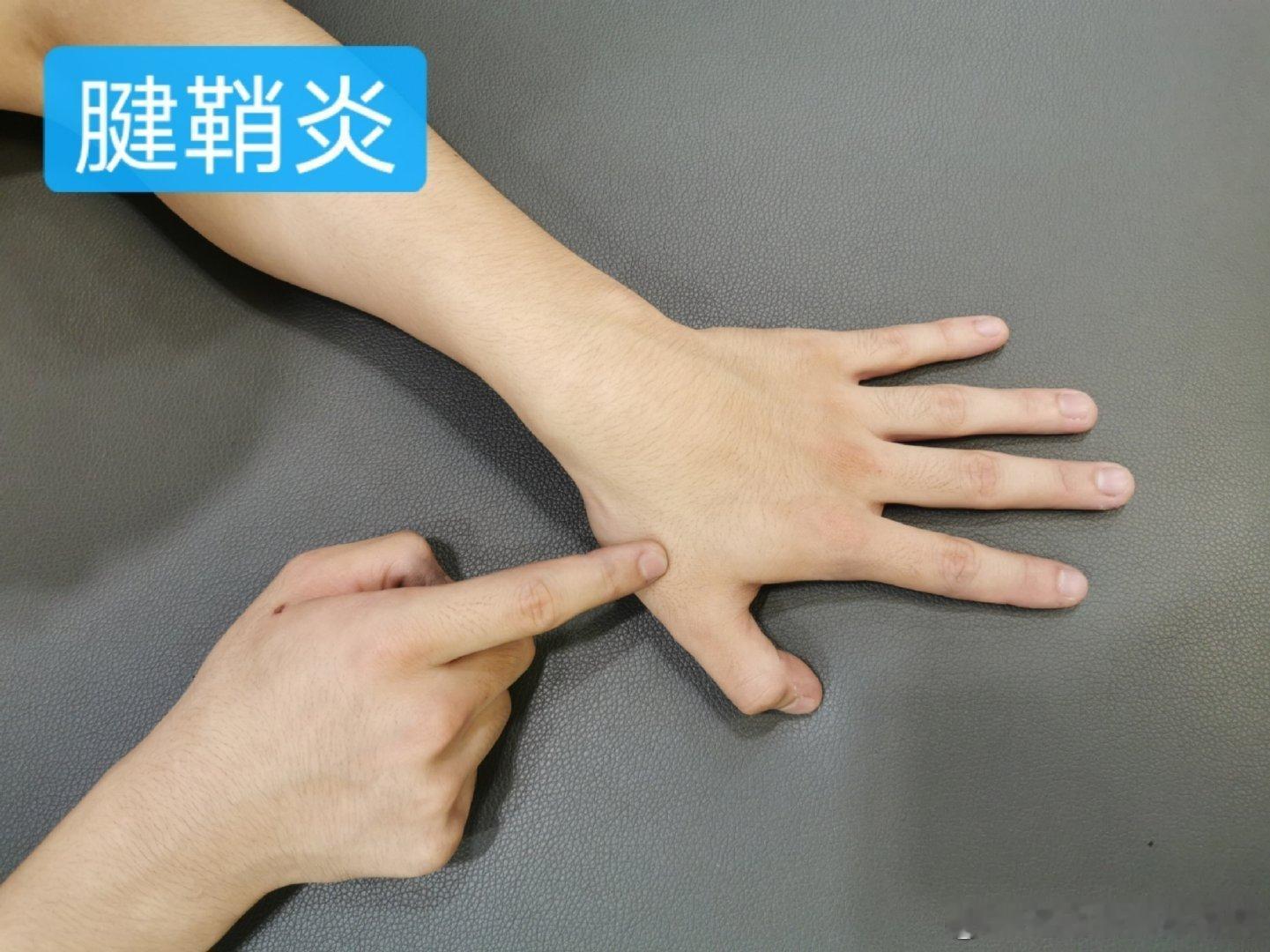 打工人常见的几种手腕疼痛节前最后一天，来做个手腕损伤的自测和训练吧！如果一直疼