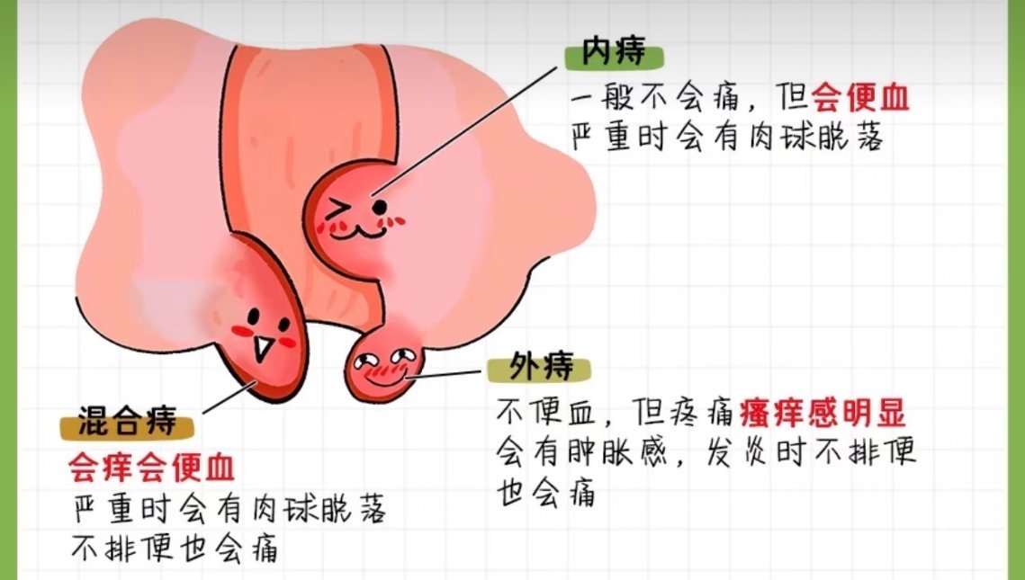三甲医生回应女子痔疮手术后自杀作为被痔疮折磨两年的