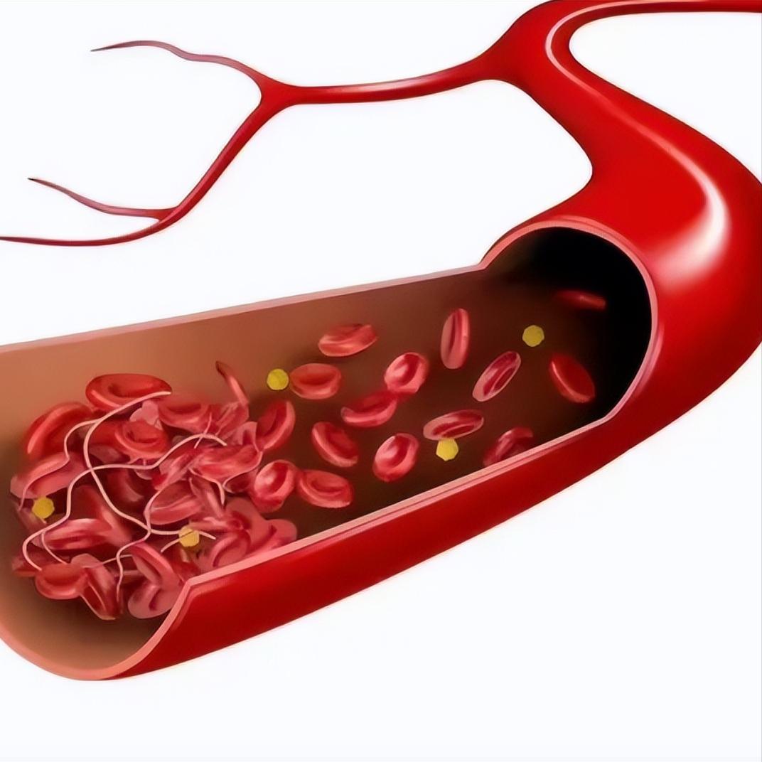 冬天最伤血管！这3类人要当心⚠️第一类：已有“三高”或心脑血管病的人。如果你