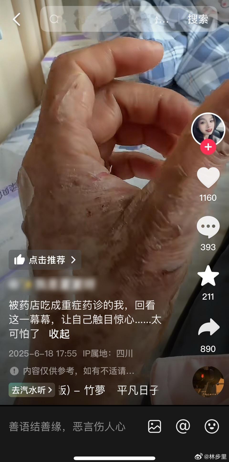 刷到一例药物过敏。感冒发烧，药店买了布洛芬与解读颗粒，结果严重过敏。第一次知道严