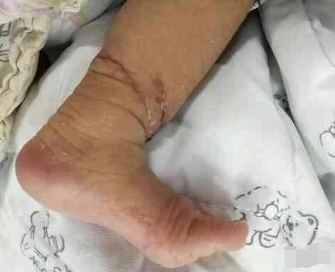 宝宝刚出生不久就面临截肢, 只因奶奶给他做了这事