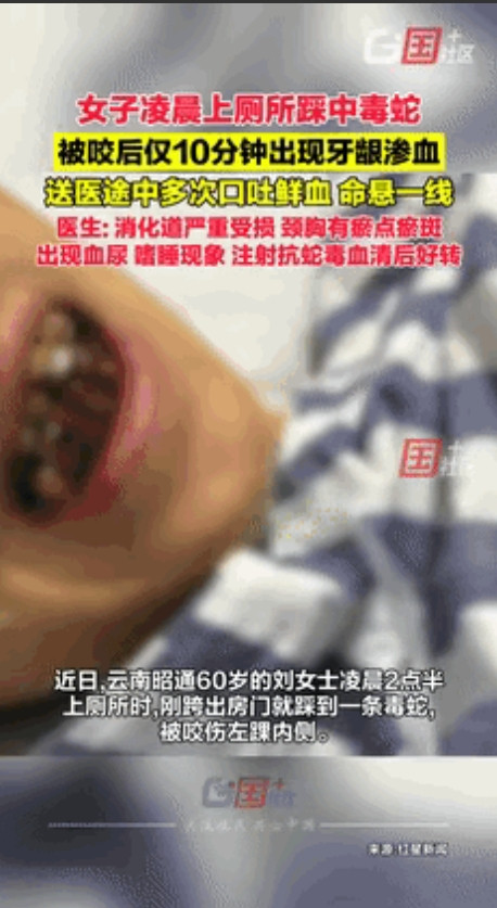 云南，60岁女子凌晨上厕所踩中毒蛇，仅10分钟后出现牙龈渗血！最可怕的是，女子并