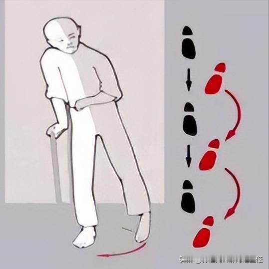 偏瘫坚持4个锻炼，轻松告别“划圈腿”！ 1.仰卧臀桥患者平躺在床上，双腿屈