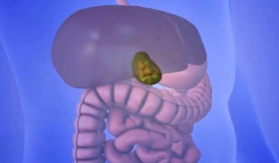 人是血肉之躯，日常饮食不会摄入土石杂质，却有不少人的胆囊内会长出坚硬结石。结