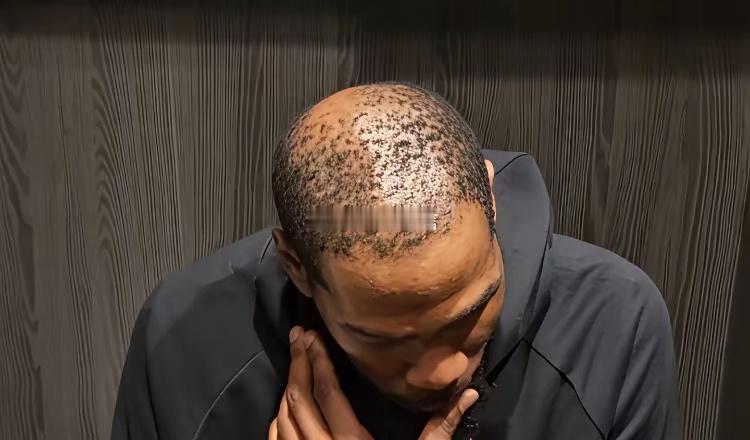 黑人也会秃头？杜兰特不舍得植发吗