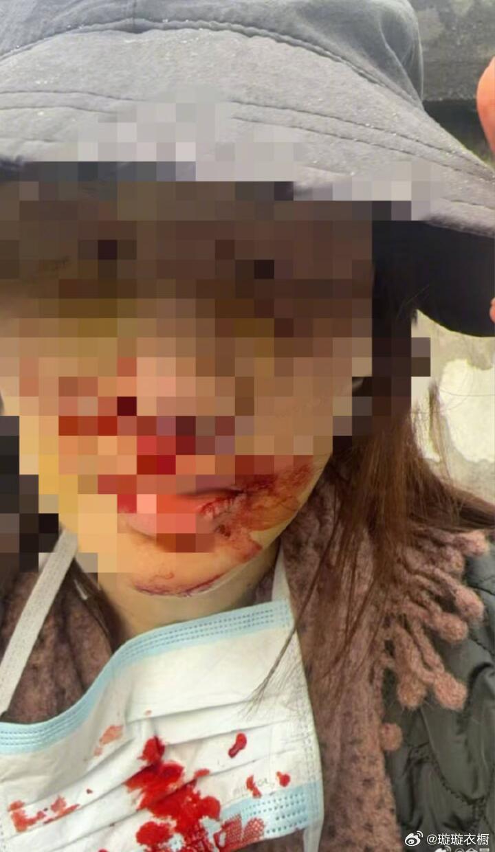 金晨车祸后口鼻受伤就医，得知助理情况立刻放弃理赔自担损失，道歉声明逻辑在线，公众