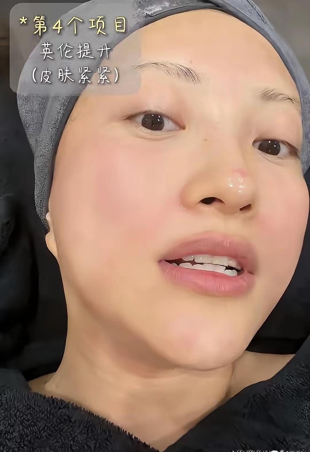 明星也得靠科技！刚刷到包文婧，39岁生完二胎火速瘦下来，转头就飞韩国做医美，就