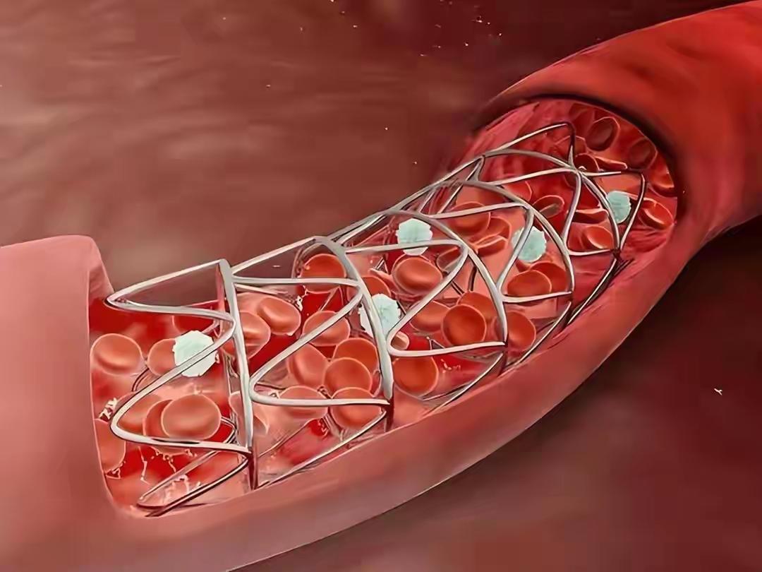 ❤️心梗后坚决不放支架会怎样？医生实话实说：两种结局，没有中间路——这不是“选
