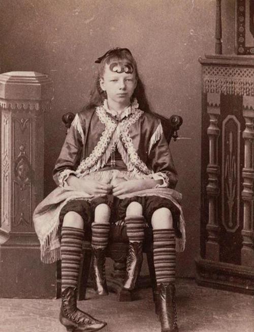 上世纪末，美国一个长着四条腿和两个生殖器官的女孩，曾被父亲高价卖给马戏团，女孩不