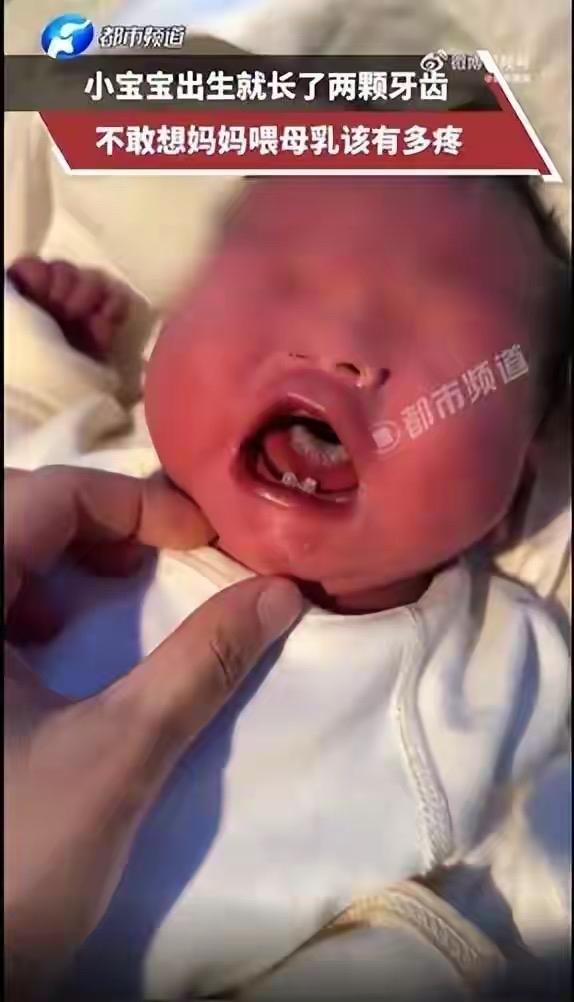 山东一婴儿刚出生嘴里就长着两颗牙，网友：不敢想妈妈喂奶该多疼！医生提醒近日，