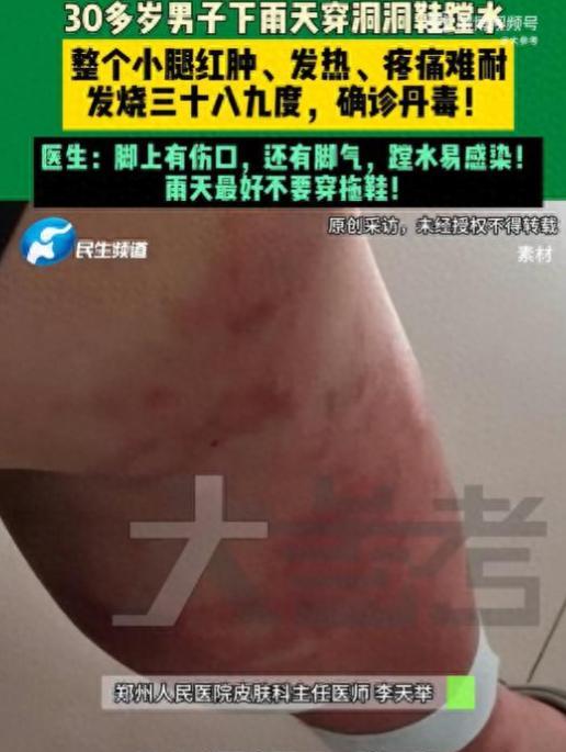 “太悲催了！”河南郑州，30岁男子雨天穿洞洞鞋蹚水，结果，回家后持续高烧38-3