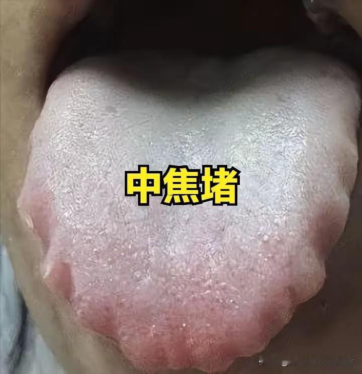 补中益气丸+参苓白术散加减：通中焦、祛脾湿，专治脾虚湿困型疲惫腹胀大家好，