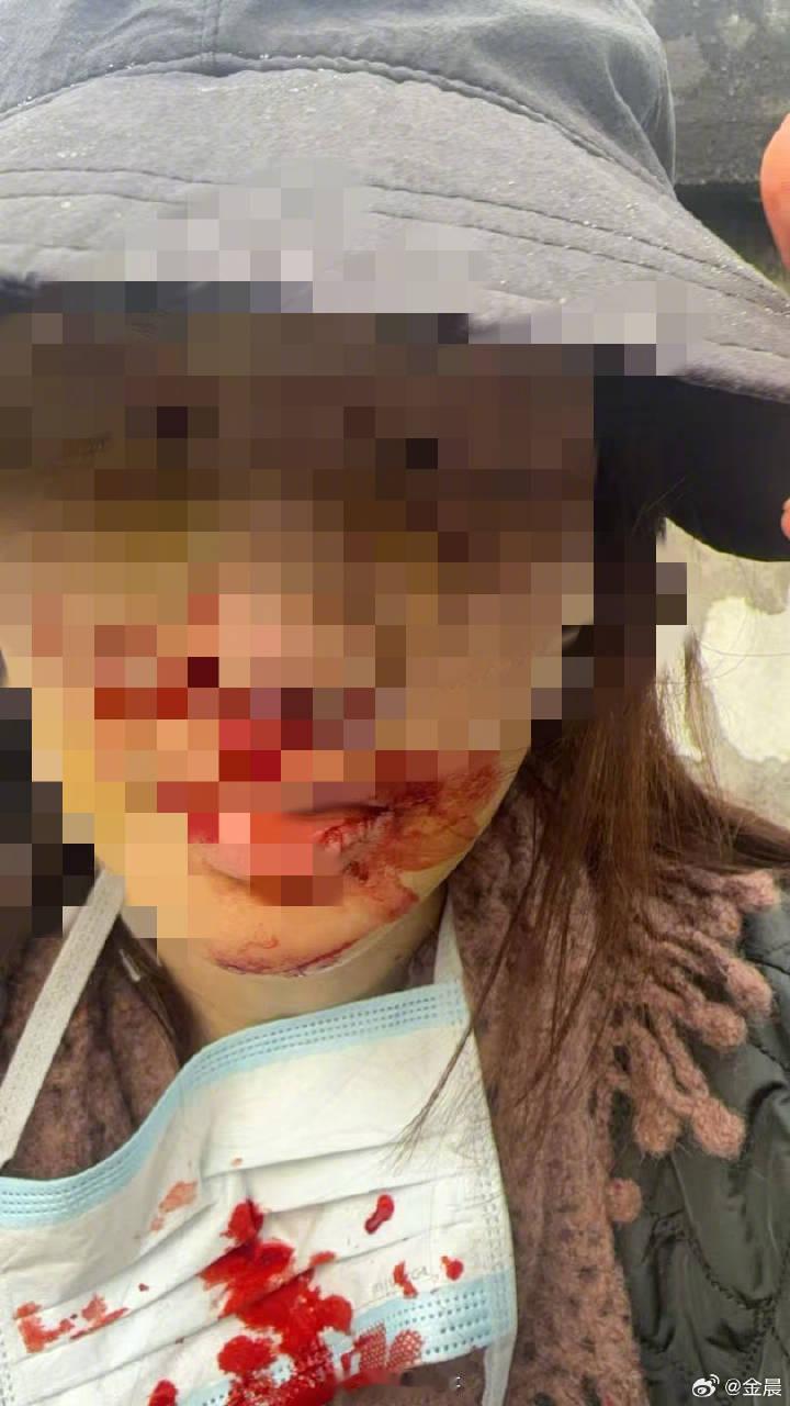 金晨回应了助理顶包自己的事，说是因为为了躲避跑出来的狗狗才撞了墙，后来因为自己受