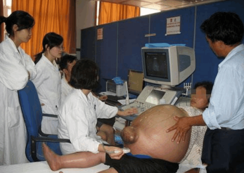 广东24岁孕妇剖腹产生5胞胎, 看到孩子性别, 医生都觉得幸福