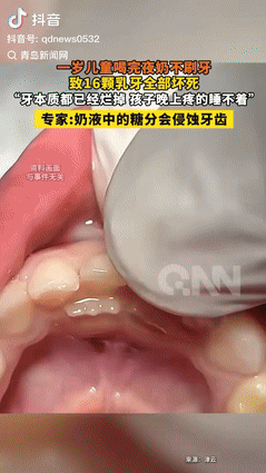 “担心的事还是发生了！”杭州，1岁儿童喝完夜奶不刷牙，结果16颗乳牙全部坏死，就