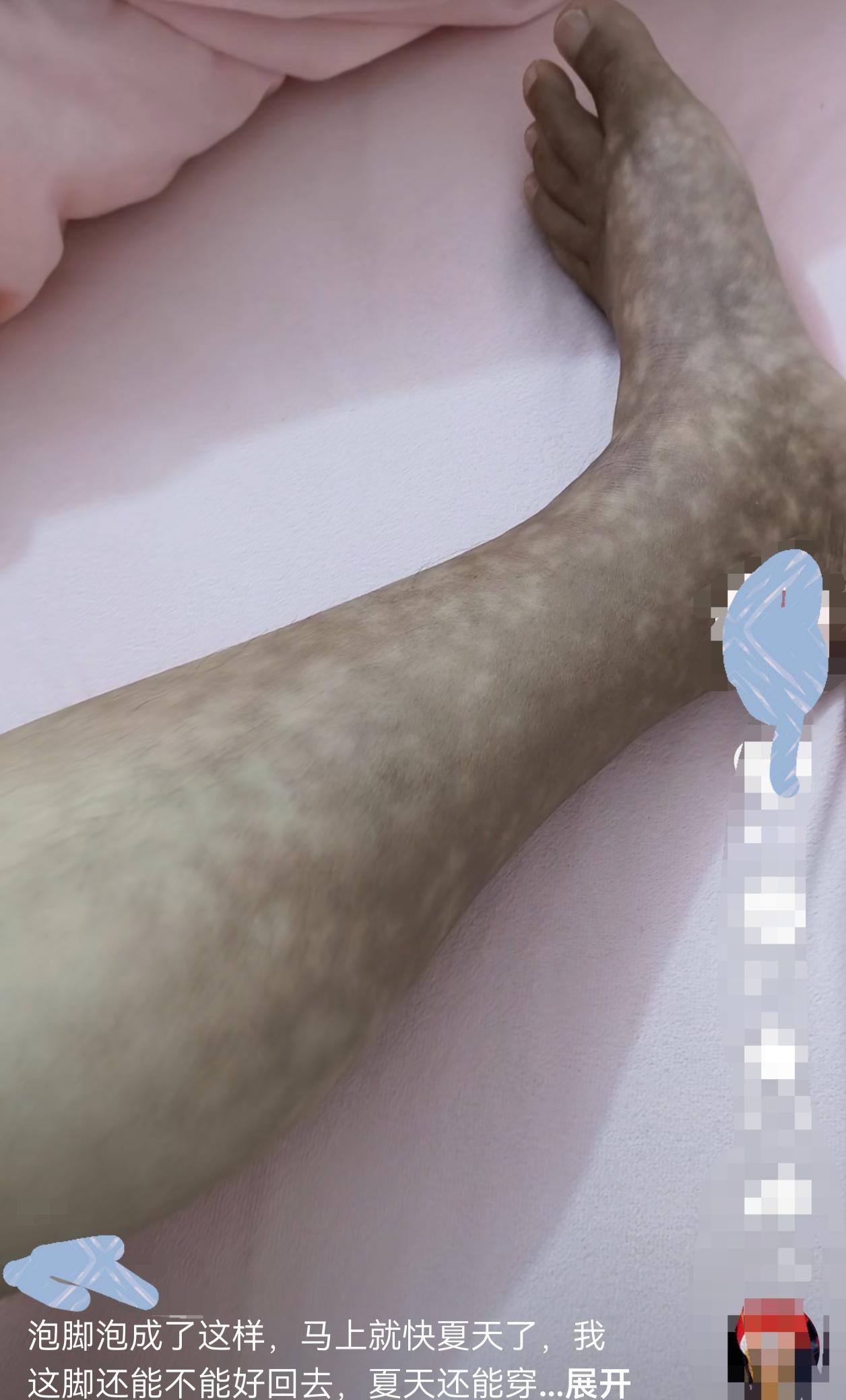 这人是真狠啊，泡个脚直接给自己烫成“血肠”了！广西，一名33岁的女子，