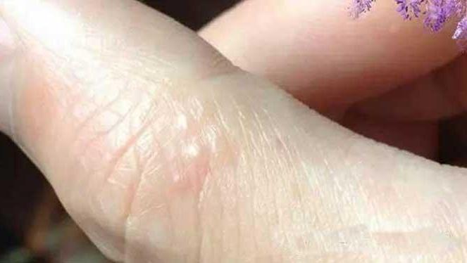 手上有小水泡是什么问题 14686933765398406134.jpg?id=0