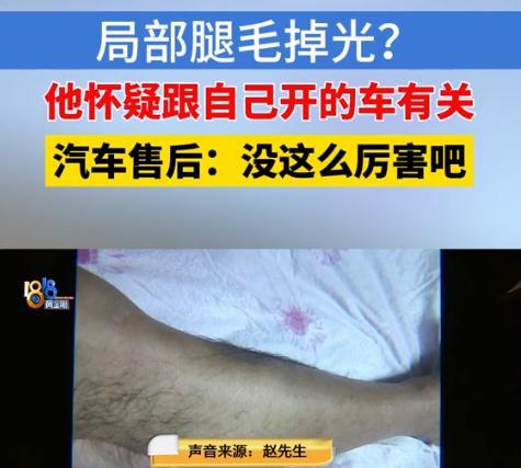 浙江诸暨，男子开新能源车1年，突然发现自己两条腿上原本茂密的毛发，竟然都掉秃了，