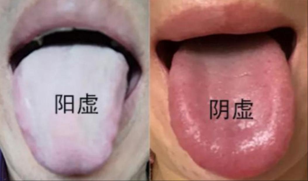 1分钟教你分辨，是肾阴虚还是肾阳虚！1、观大便阴虚：阴虚的人体内阴液不足，肠