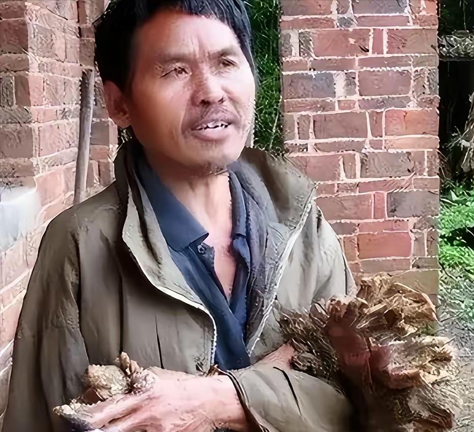 “我快要疼死了！”1992年，湖南小伙半夜惊醒，浑身火急火燎的疼，他开灯仔细一看