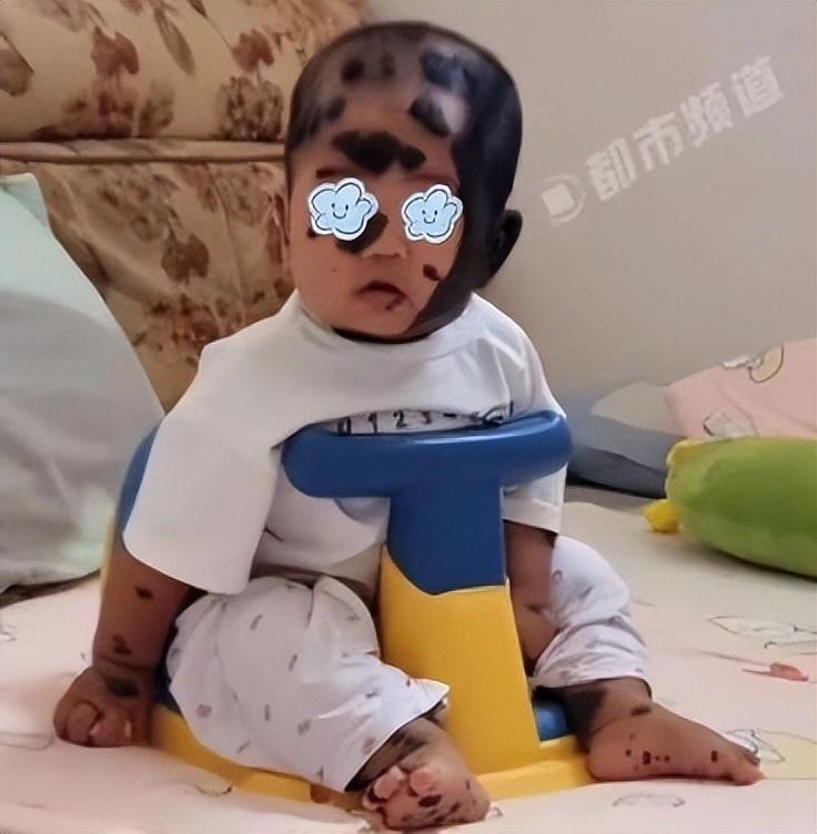 最近“宝宝产检正常，出生却满身兽皮痣”的消息登上热搜。河南一位宝妈称，儿子产检“