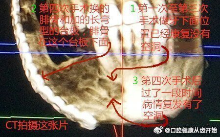 #女子买的八角数出13个角竟有剧毒#广东省深圳市北京大学深圳医院做的5次手术，第1次至第3次手术做根