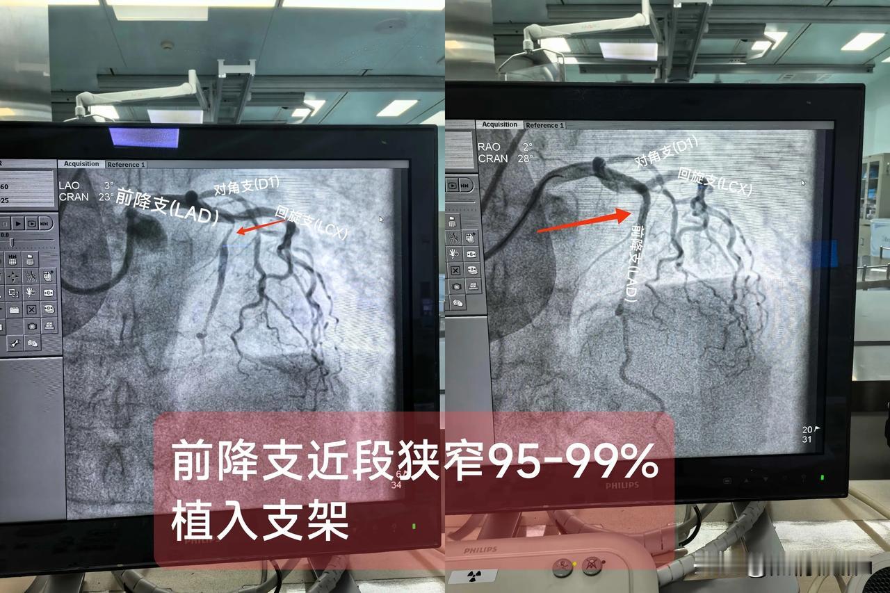 急性ST段抬高型心肌梗死（前降支近段狭窄90∽95）一.概念：前降支主要为